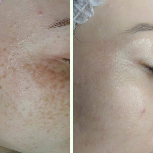 Résultats avant-après Facial Peeling MeLine