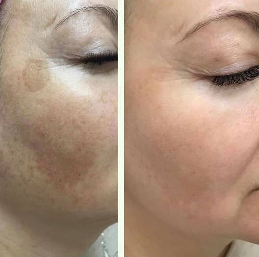 Résultats avant-après Facial Peeling MeLine 2