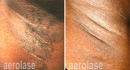 Épilation laser aerolase