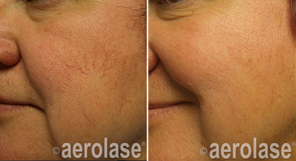 Vasculaire visage laser aerolase