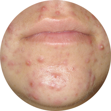 peau acné