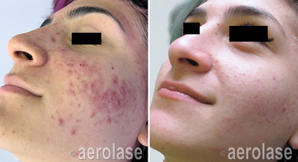 Traitement acné laser aerolase