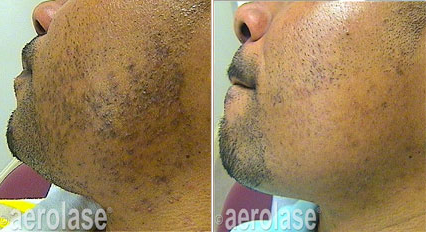Traitement de la pseudo-folliculite de la barbe laser aerolase