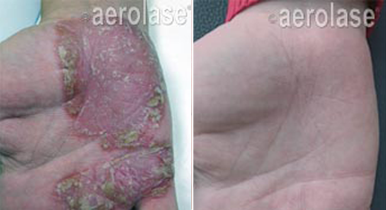 Traitement du psoriasis et eczéma laser aerolase